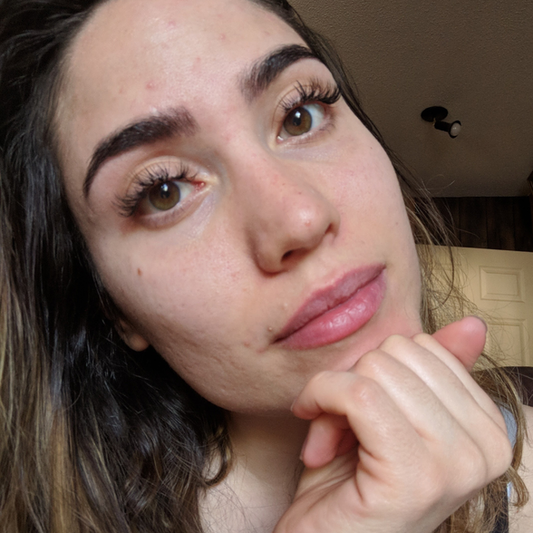 Vanessa Kay - My Personal Journey With Acne